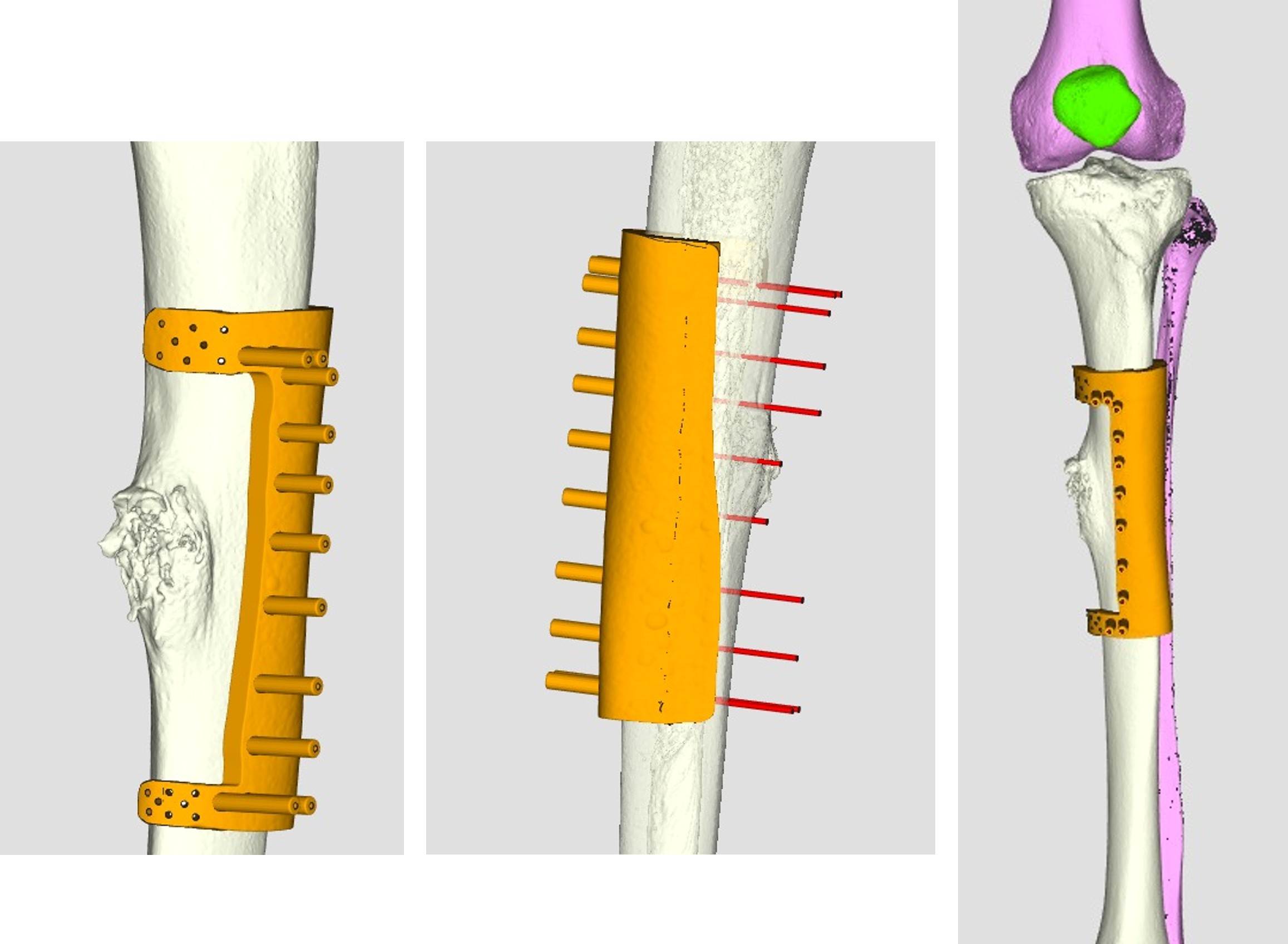 3D printed anatomical model used for surgical planning