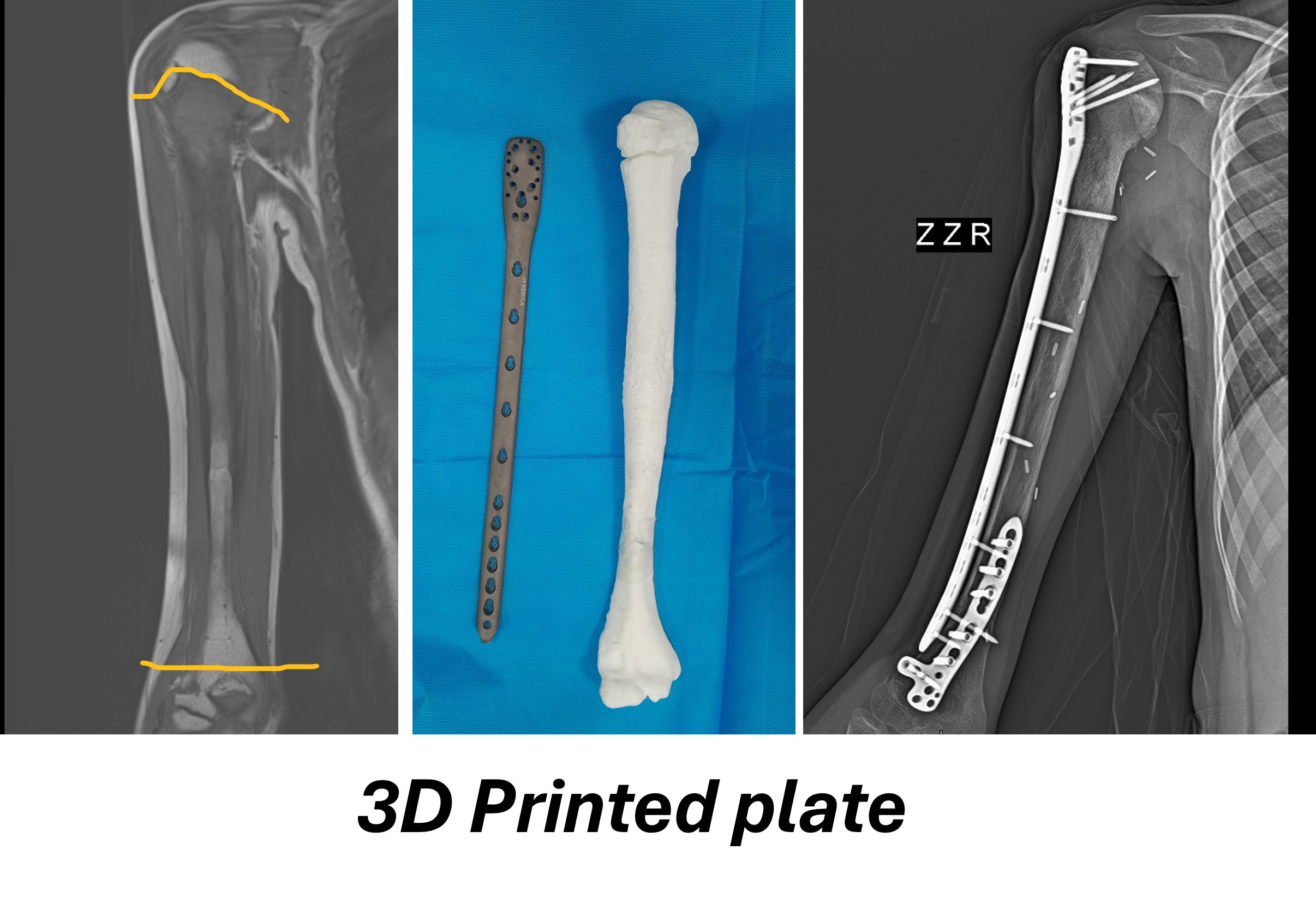 Custom 3D printed medical implant designed for patient-specific needs