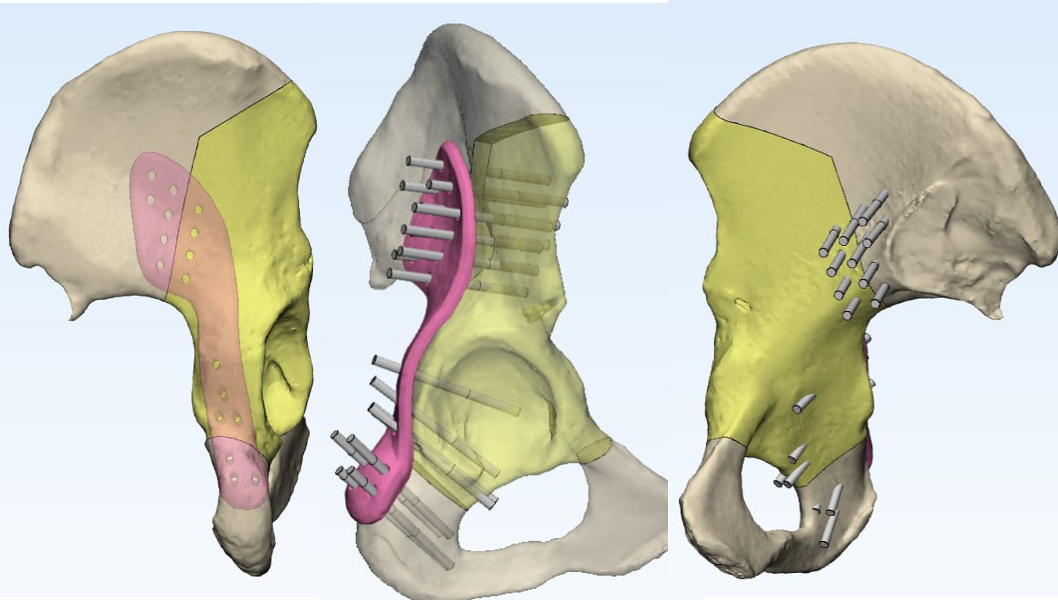 Custom 3D printed medical implant designed for patient-specific needs